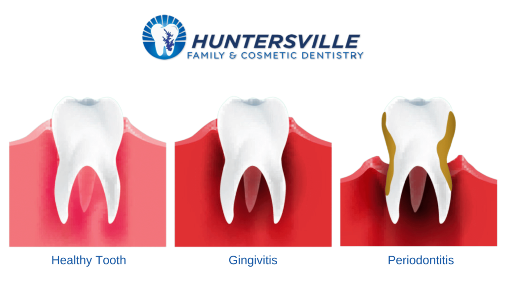 Gum Disease Progression & Treatment