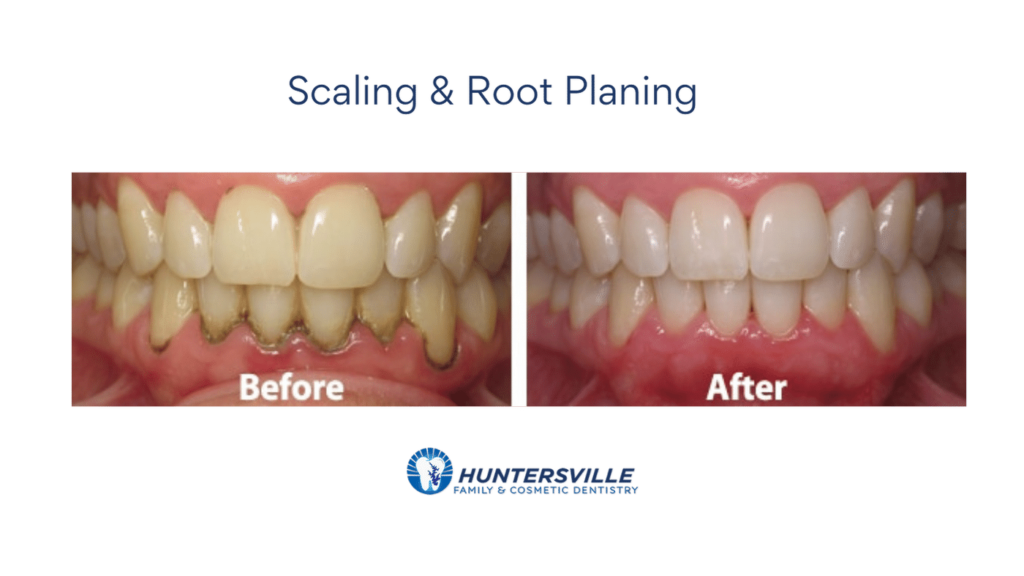 scaling and root planing