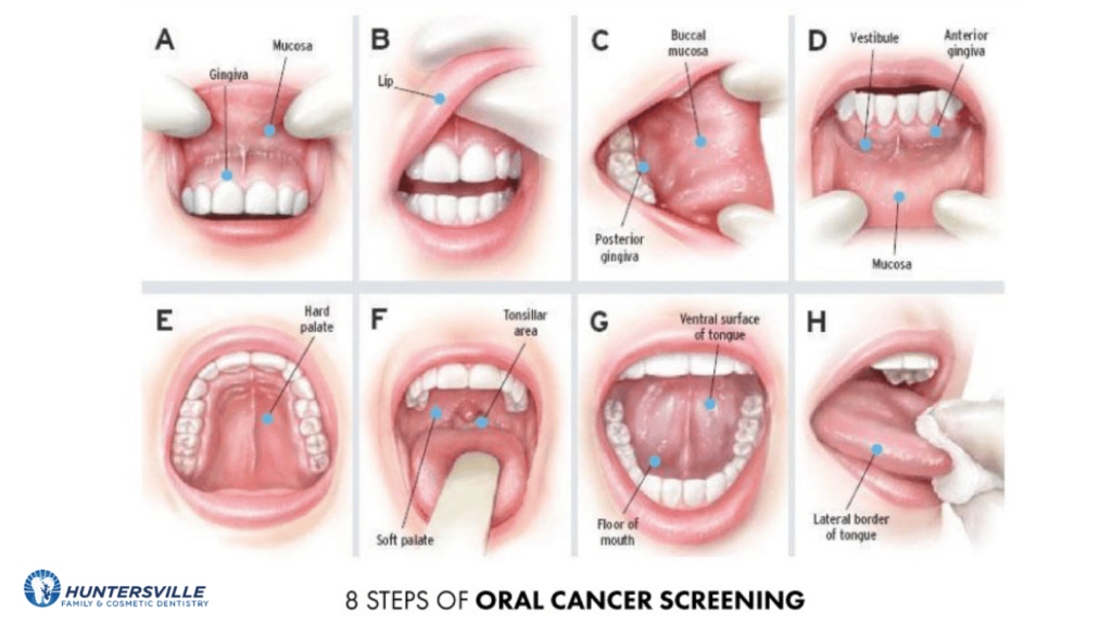 oral cancer screenings