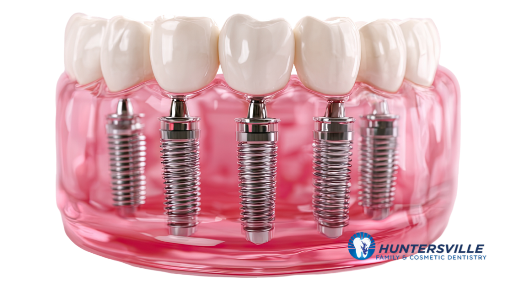 dental implant posts inserted in the gums by dentist in huntersville, nc