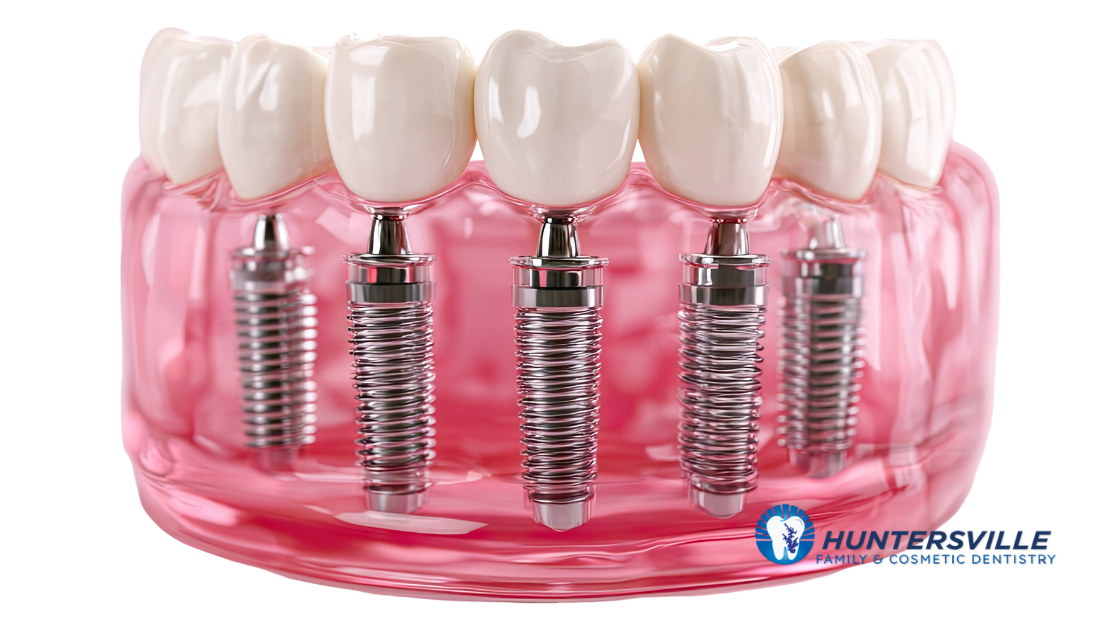dental implant posts inserted in the gums by dentist in huntersville, nc